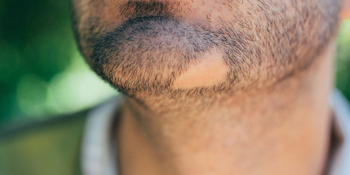 Alopecia Barbae: What Causes It & What Can You Do About It?